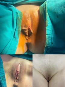 Résultats avant et après vaginoplastie à ID Clinic Bangkok, reconstruction vaginale visible