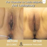 Résultats avant/après transfert de graisse et labiaplastie à ID Clinic Bangkok