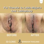 Résultats avant/après labiaplastie et lipofilling des grandes lèvres à ID Clinic Bangkok