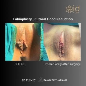 Résultats avant et après labiaplastie et réduction du capuchon clitoridien à ID Clinic Bangkok