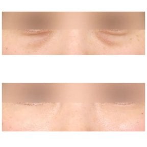 Resultados de blefaroplastia de párpado inferior antes y después en AB Plastic Surgery