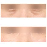 Resultados de blefaroplastia de párpado inferior antes y después en AB Plastic Surgery