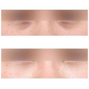 Resultados de blefaroplastia de párpado inferior antes y después en AB Plastic Surgery