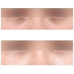 Resultados de blefaroplastia de párpado inferior antes y después en AB Plastic Surgery