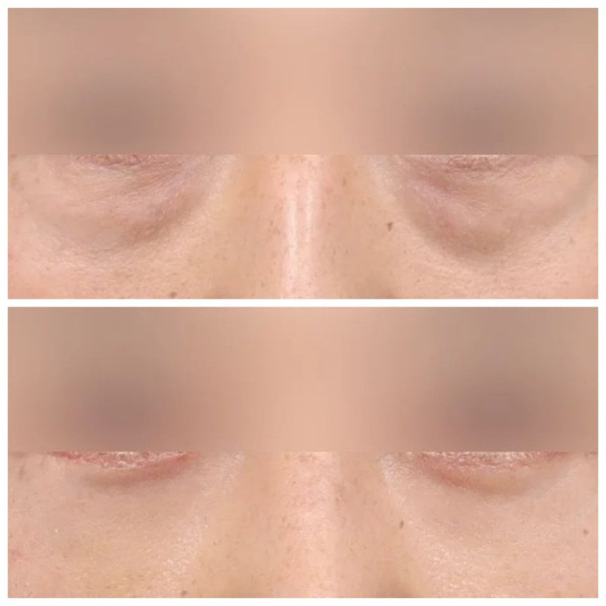 Resultados de blefaroplastia de párpado inferior antes y después en AB Plastic Surgery, menos bolsas