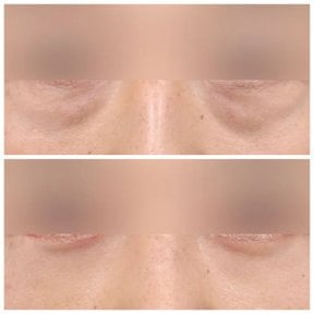 Resultados de blefaroplastia de párpado inferior antes y después en AB Plastic Surgery, menos bolsas