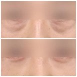 Resultados de blefaroplastia de párpado inferior antes y después en AB Plastic Surgery, menos bolsas