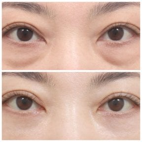Resultados de blefaroplastia de párpado inferior en AB Plastic Surgery, reducción de bolsas