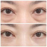 Resultados de blefaroplastia de párpado inferior en AB Plastic Surgery, reducción de bolsas