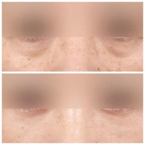 Resultados de blefaroplastia inferior antes y después en AB Plastic Surgery, menos bolsas