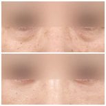 Resultados de blefaroplastia inferior antes y después en AB Plastic Surgery, menos bolsas