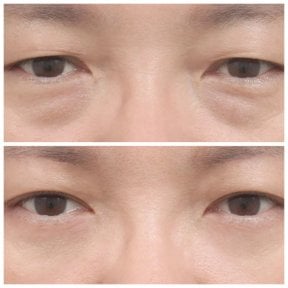 Resultados de blefaroplastia inferior antes y después en AB Plastic Surgery, menos bolsas