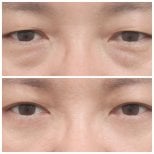 Resultados de blefaroplastia inferior antes y después en AB Plastic Surgery, menos bolsas