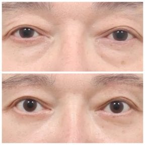 Resultados de blefaroplastia de párpado inferior antes y después en AB Plastic Surgery, menos bolsas