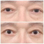 Resultados de blefaroplastia de párpado inferior antes y después en AB Plastic Surgery, menos bolsas