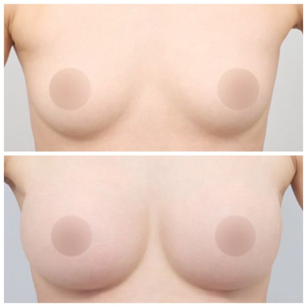 Resultados antes y después de aumento de senos en AB Plastic Surgery – mayor volumen mamario