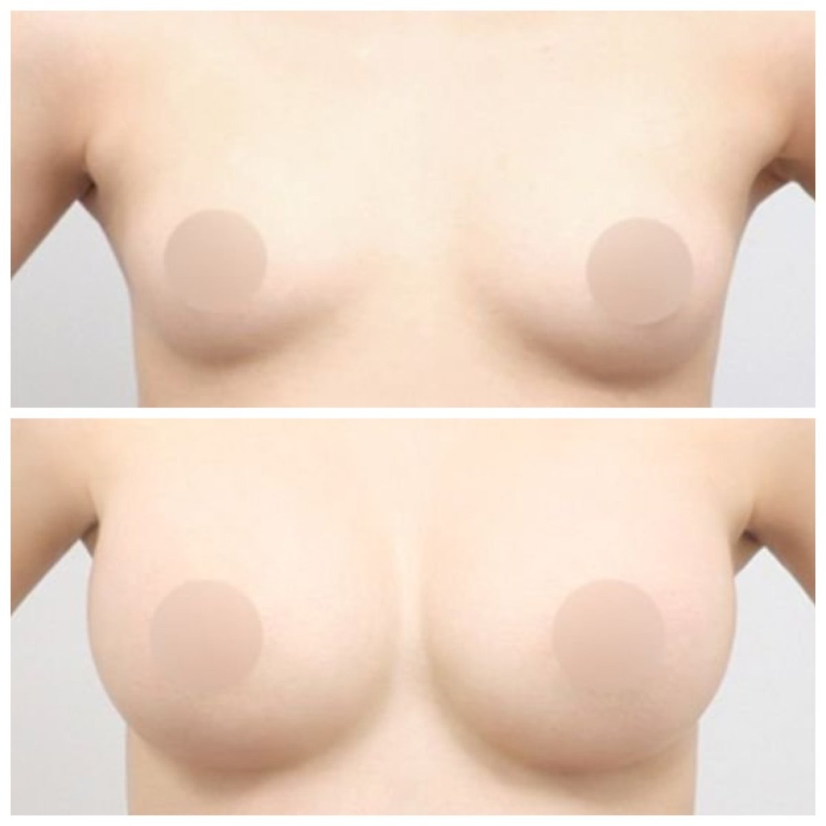 نتائج قبل وبعد تكبير الثدي في AB Plastic Surgery، زيادة حجم الثدي