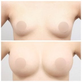 Resultados antes y después de aumento de senos en AB Plastic Surgery, mayor volumen mamario