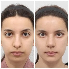 Resultados antes y después de Fox Eye Lift en AB Plastic Surgery, contorno ocular mejorado