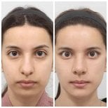 Resultados antes y después de Fox Eye Lift en AB Plastic Surgery, contorno ocular mejorado
