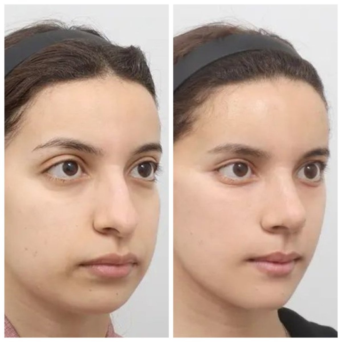 Resultados antes y después de Fox Eye Lift en AB Plastic Surgery, contorno de ojos mejorado