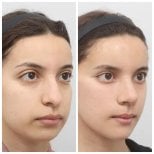 Resultados antes y después de Fox Eye Lift en AB Plastic Surgery, contorno de ojos mejorado