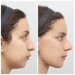Resultados antes y después de Fox Eye Lift en AB Plastic Surgery, contorno ocular mejorado