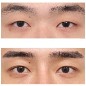 Resultados de blefaroplastia antes y después en AB Plastic Surgery, corrección de párpados