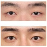 Resultados de blefaroplastia antes y después en AB Plastic Surgery, corrección de párpados