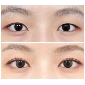 Resultados de blefaroplastia superior antes y después en AB Plastic Surgery – ojos rejuvenecidos