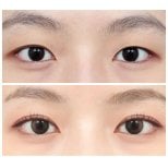 Resultados de blefaroplastia superior antes y después en AB Plastic Surgery – ojos rejuvenecidos