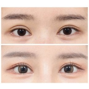 Resultados de blefaroplastia superior en AB Plastic Surgery, mirada más luminosa