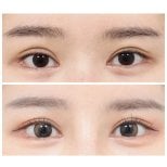 Resultados de blefaroplastia superior en AB Plastic Surgery, mirada más luminosa
