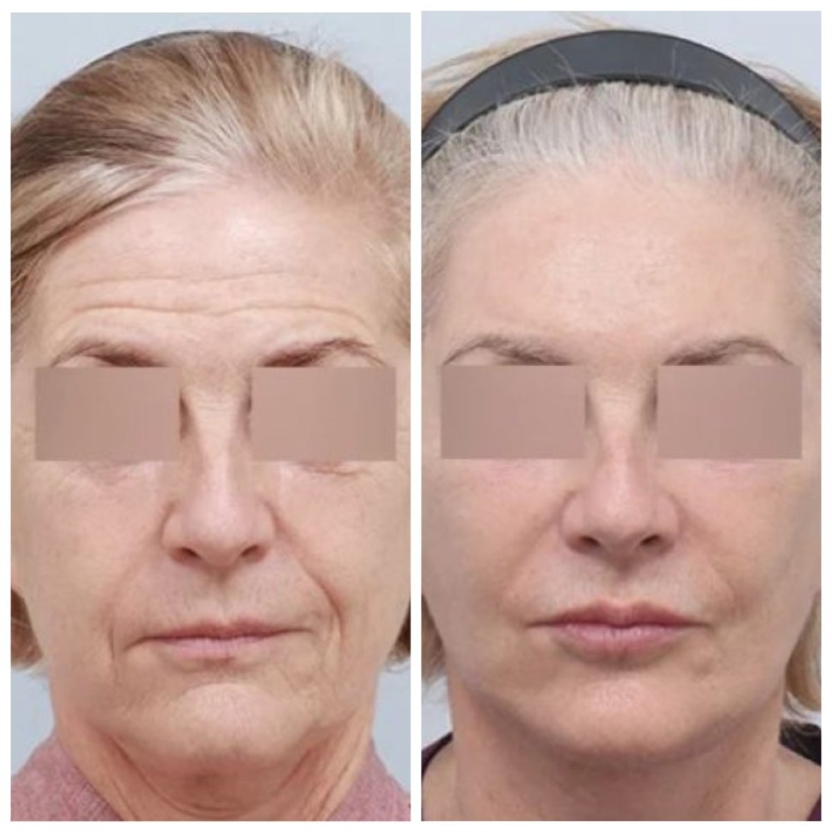 نتائج شد الجبهة قبل وبعد في AB Plastic Surgery – جبهة أكثر نعومة وشبابًا