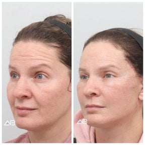 Resultados de lifting facial antes y después en AB Plastic Surgery, rejuvenecimiento visible