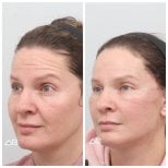 Resultados de lifting facial antes y después en AB Plastic Surgery, rejuvenecimiento visible