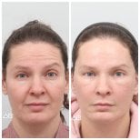 Resultados de lifting facial antes y después en AB Plastic Surgery, rejuvenecimiento visible