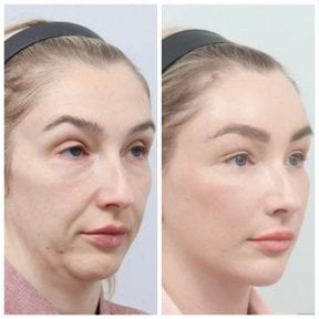 Resultados de lifting facial antes y después en AB Plastic Surgery – rejuvenecimiento visible