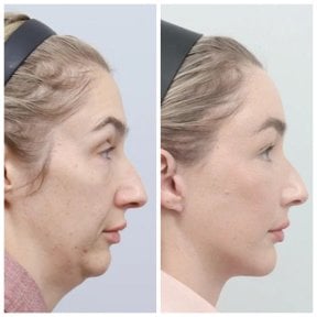 Resultados de lifting facial antes y después en AB Plastic Surgery, mandíbula definida