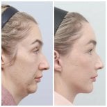 Resultados de lifting facial antes y después en AB Plastic Surgery, mandíbula definida