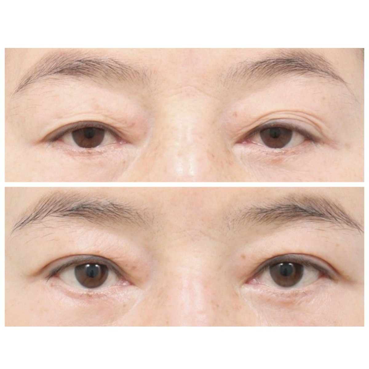 نتائج قبل وبعد جراحة الجفن في AB Plastic Surgery، تصحيح الجفون بوضوح