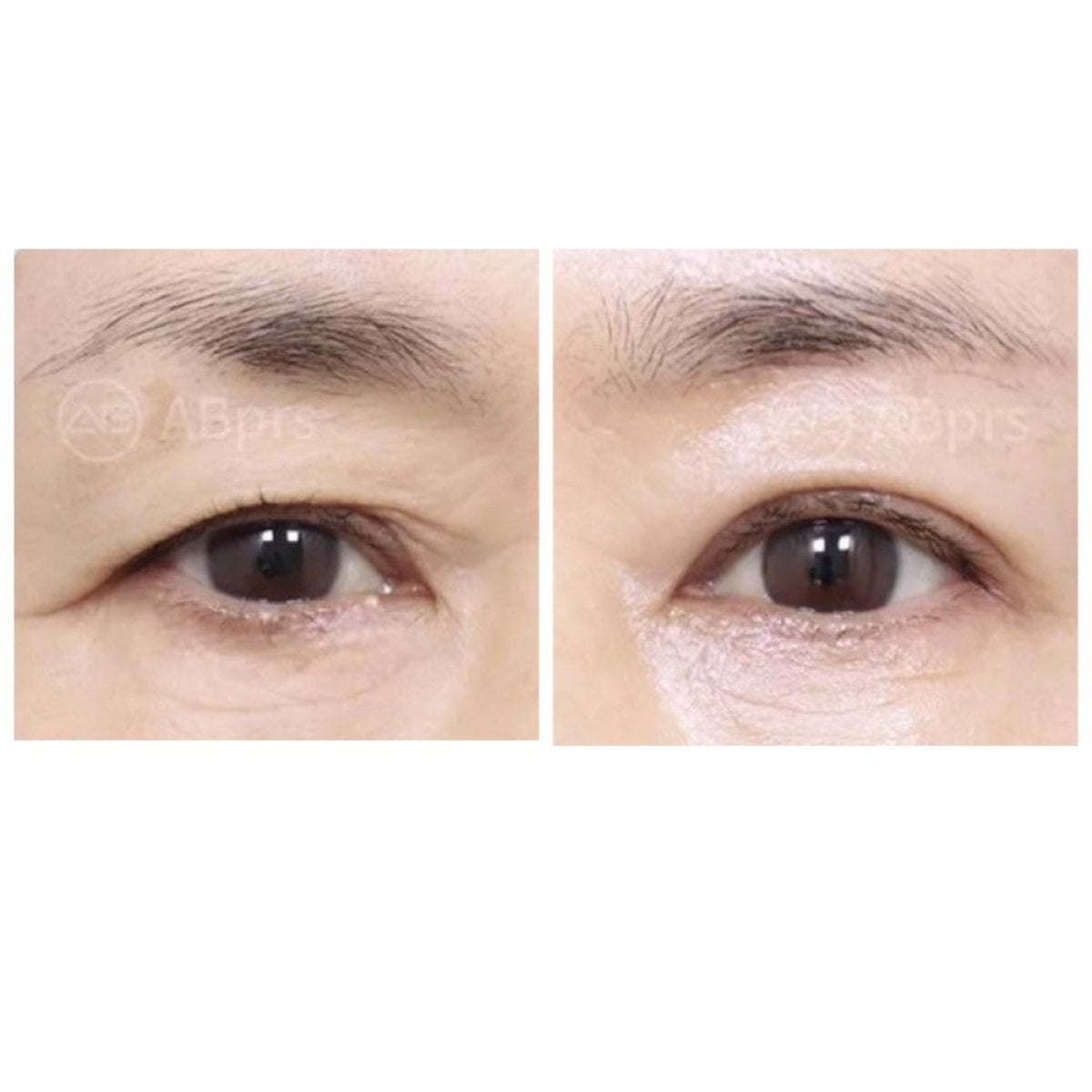 Resultados de blefaroplastia antes y después en AB Plastic Surgery, mejora de párpados