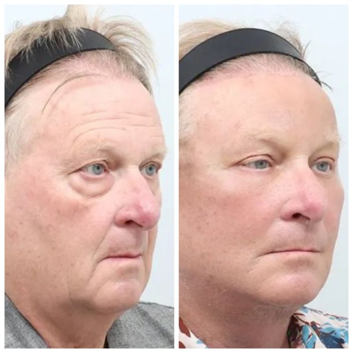 نتائج شد الوجه العميق قبل وبعد في AB Plastic Surgery، تجديد شباب الوجه بوضوح