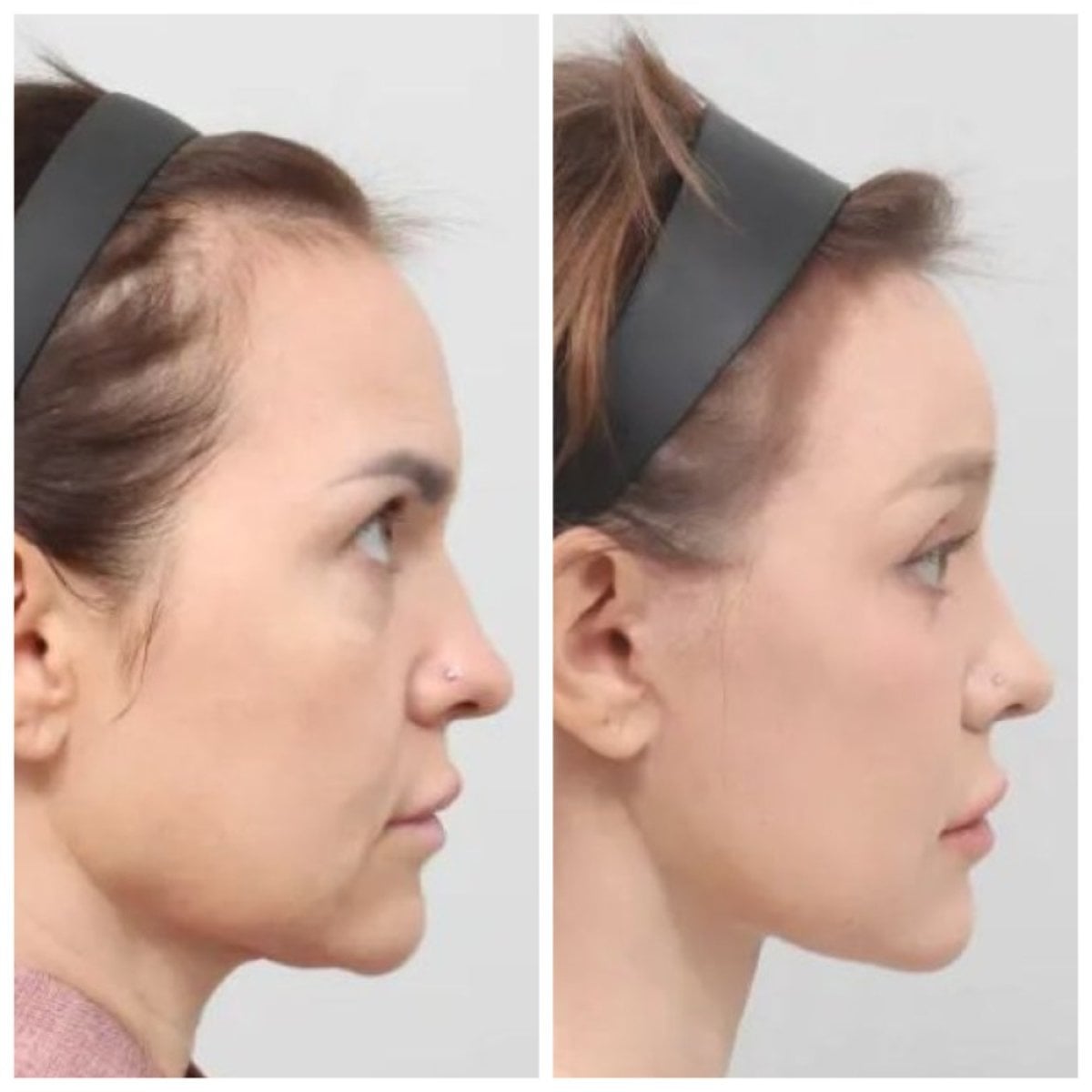 Resultados antes y después de deep plane facelift en AB Plastic Surgery – mejora del contorno facial