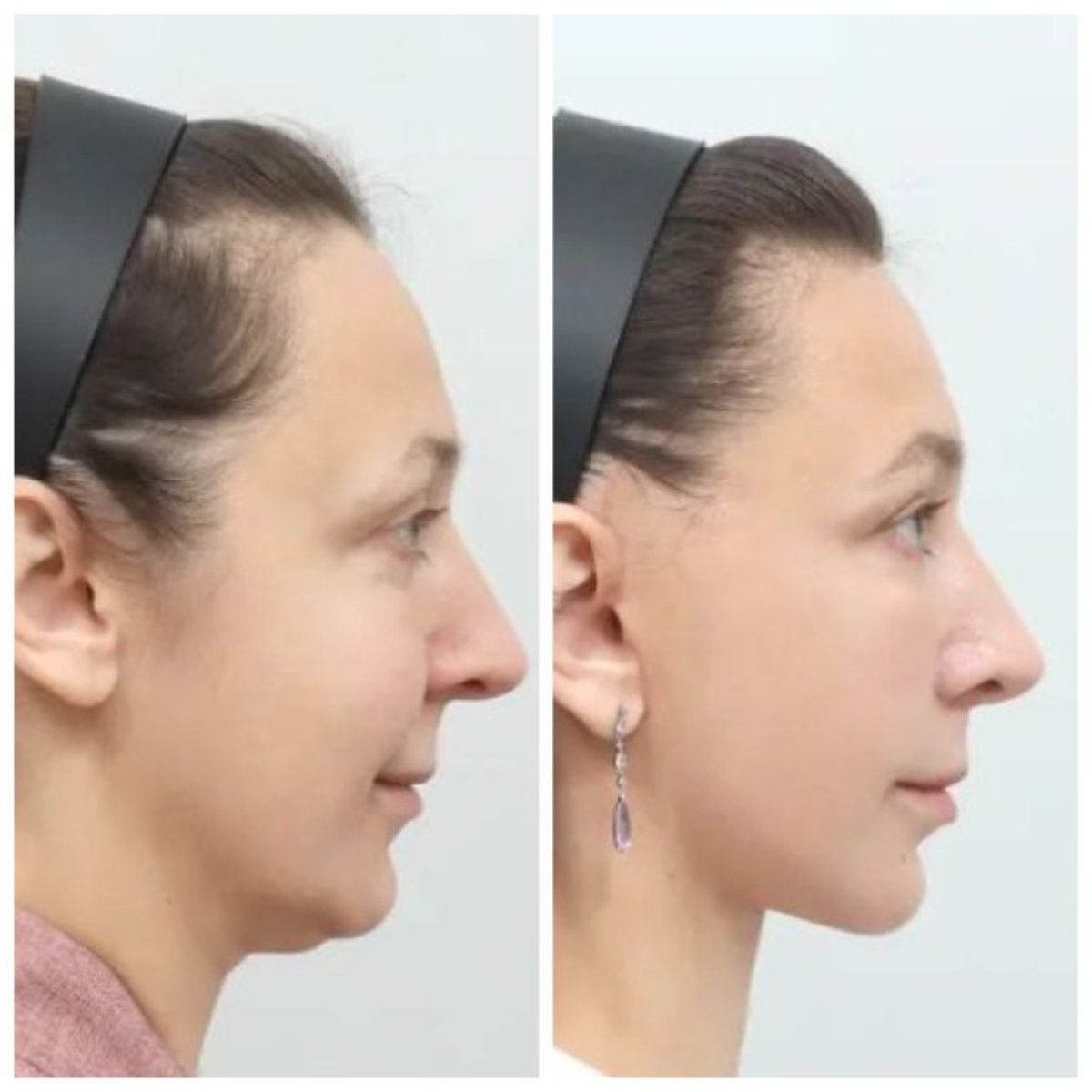 نتيجة شد الوجه العميق قبل وبعد في AB Plastic Surgery – تحسين واضح لخط الفك