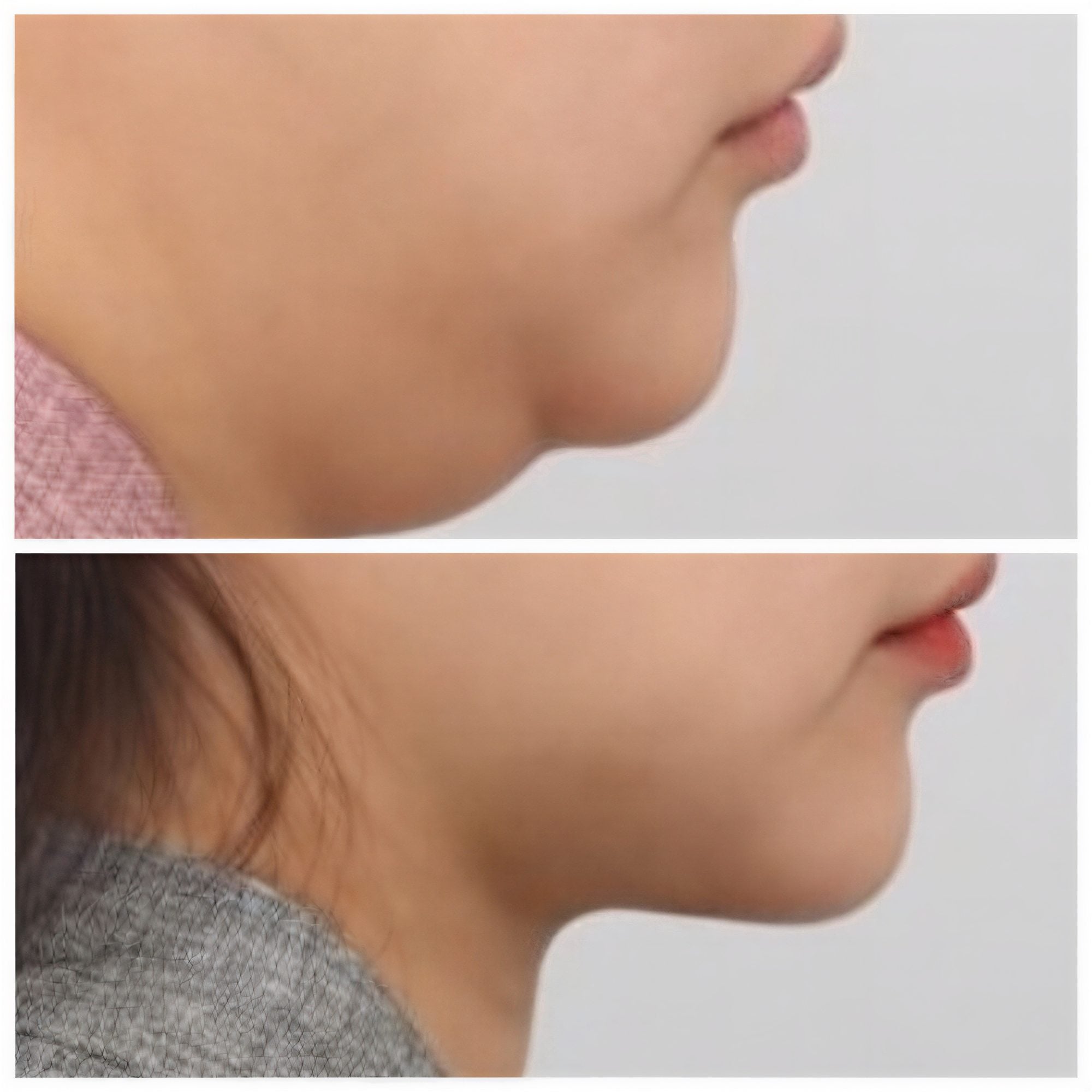 نتائج شفط دهون الذقن قبل وبعد في AB Plastic Surgery – تحديد الفك بشكل أفضل