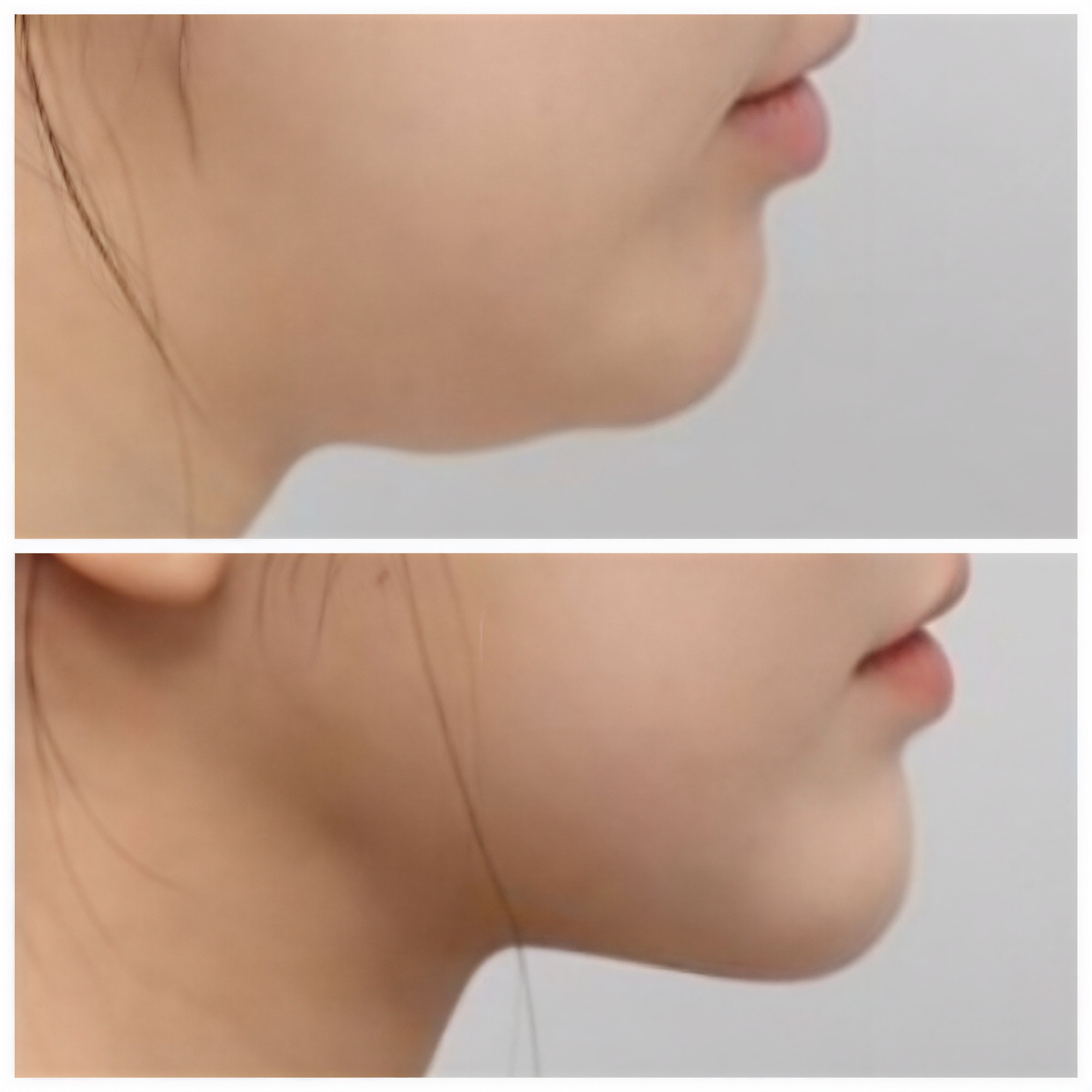 نتائج شفط دهون الذقن قبل وبعد في AB Plastic Surgery – تحديد الفك المحسن