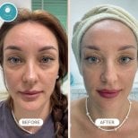 Before and after Botox injections result at Nicha Clinic Pattaya- Aesthetic & Wellness, smoother forehead