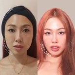 Before and after Botox jaw slimming results at Nicha Clinic Pattaya- Aesthetic & Wellness