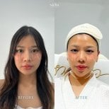 Before and after Botox injections at Nicha Clinic Pattaya- Aesthetic & Wellness, facial slimming result